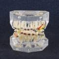 Модел на Зъбите, Модел на Зъбите с Метална Верига, Зъбни Ортодонтско Лечение, Изследвания Неправилно привеждане
